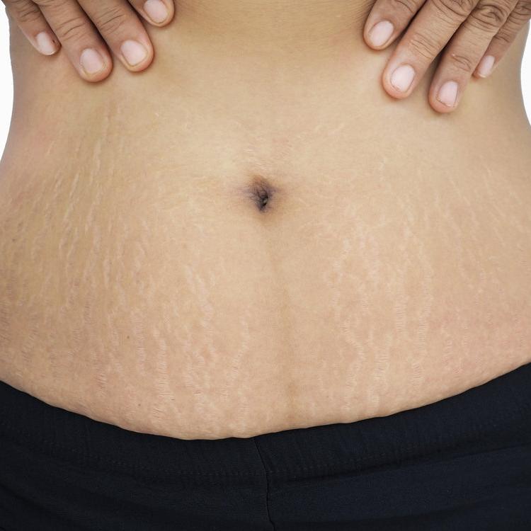 Stretch Marks & Scar Camouflage